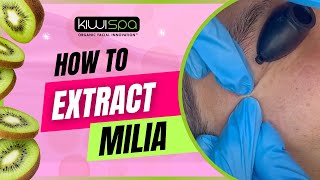 How to Extract Milia Causes and Effective Extraction Techniques [upl. by Oiliduab311]