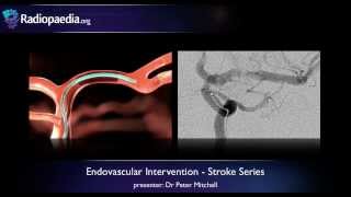 Stroke Endovascular management of ischaemic stroke  radiology video tutorial [upl. by Sophi]