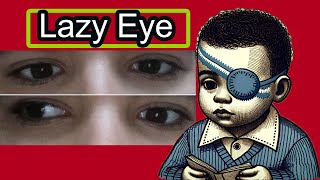 Lazy Eye Amblyopia From Diagnosis to Full Recovery Causes Effects and Treatment Strategies [upl. by Nawed]