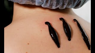 Leech Therapy Ancient Treatment Reborn Today leechtherapy medicinalleeches Hirudomedicinalis [upl. by Yatnahc]