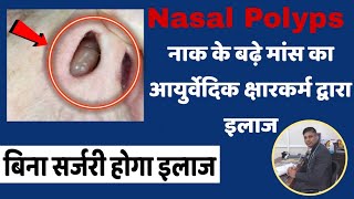 नाक मे बढे मांस Nasal Polyp का आयुर्वेदिक Kshar Sutra द्वारा बिना सर्जरी छुटकारा l Dr Anuj Tyagi [upl. by Carena]