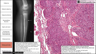 Bone and cartilage tumors [upl. by Dane]