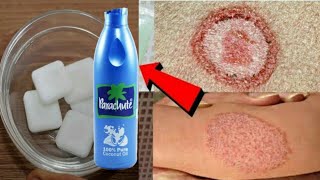 सिर्फ 2 दिन मे दाद खाज खुजली Fungal infectionको जड़ से खत्म करने का रामबाण उपायRingworm treatment [upl. by Abihsot]