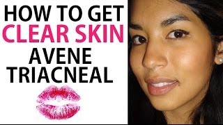 Use Drugstore AntiAcne Cream to Clear Up Acne Avene TriAcneal Review [upl. by Rebmac]