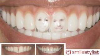 Close Teeth Gaps  Spaces Between Teeth Find a Cosmetic Dentist [upl. by Balbinder]