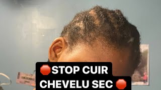 COMMENT LUTTER CONTRE LE CUIR CHEVELU SEC  ACTIFS ASTUCES [upl. by Kedezihclem]