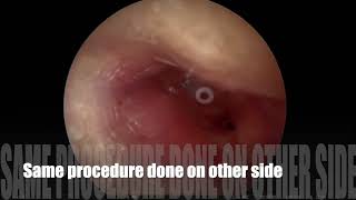 Endoscopic myringotomy with grommet insertion [upl. by Bourn]