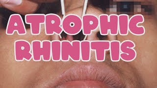 Atrophic rhinitis [upl. by Girardo169]