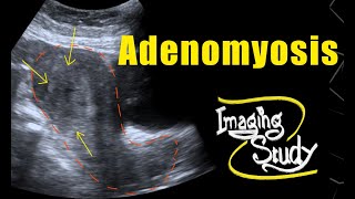 Adenomyosis  Ultrasound  Case 69 [upl. by Rolo659]