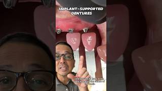 Preparing for Implant Supported Dentures  In Office to Hands On Dental Training shorts [upl. by Nylkaj147]