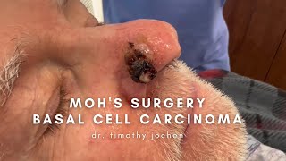 Nose Basal Cell Carcinoma treated with Mohs Surgery [upl. by Nagear]