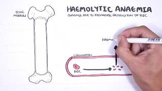 Haemolytic Anaemia  classification intravascular extravascular pathophysiology investigations [upl. by Oiramrej179]