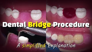 Dental Bridge Procedure [upl. by Anitnerolf]