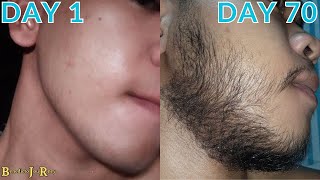 Minoxidil Beard Journey 10 WEEK TRANSFORMATION [upl. by Dhu902]