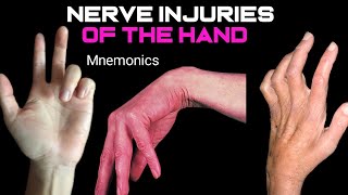 Claw HandWrist DropApe Hand in Urdu and HindiNerves injuries of the hand Nerve mbbsusmile [upl. by Zinnes770]