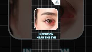 Safe Eye Makeup After LASIK Surgery  Tips for Safe Eye Makeup After LASIK Surgery [upl. by Darrow138]