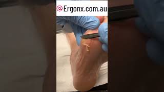 Foot callus cutting is satisfying to watch [upl. by Sulamith329]