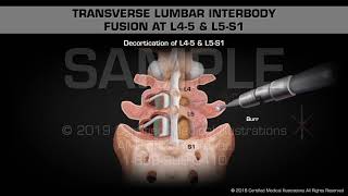 Transverse Lumbar Interbody Fusion at L45 amp L5S1  Medical Animation [upl. by Franz798]