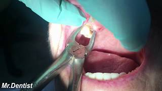 Extraction Of Molar Tooth [upl. by Otaner]