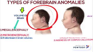 Forebrain anomalies part 1 [upl. by Ahsad]