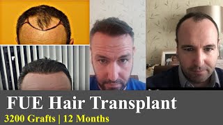 Dr Bisanga  Hair Transplant Results 3200 FUE 012 Months FullFace  Testimonials  BHR Clinic [upl. by Assillim570]