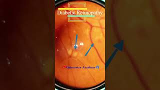 Diabetic retinopathy  Hemorrhages  cotton wool spots  Hard exudates  Fundus  Short Video 173 [upl. by Anahsit948]