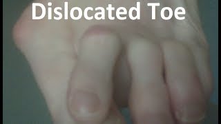 Dislocated Toe Pain Home Treatment Guide [upl. by Eivod869]