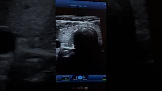 Hashimoto Tyroiditis Ultrasound  Hypothyroidism Sonography  ARDMS [upl. by Artimid541]