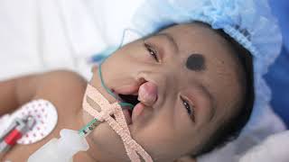 Rare Cleft Baby Going under Sleep Anesthesia [upl. by Eurydice]