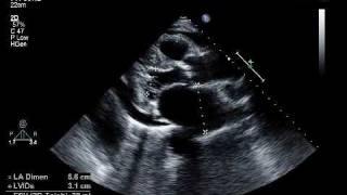 EchoWeb  Aortic Stenosis and Pericardial Effusion [upl. by Nauh40]