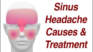 Sinus Headaches Causes amp Treatment [upl. by Alegnave]