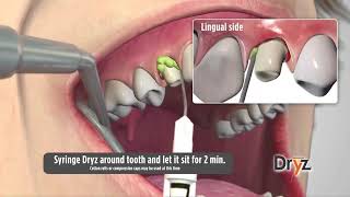 Dryz® Hemostatic Retraction Paste by Parkell Inc [upl. by Tenom36]