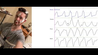 Orientation to Polysomnography [upl. by Carie]