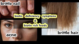 Biotin rich foods biotin deficiency biotin for hair growth healthvlog healthyfood biotin [upl. by Eilliw]