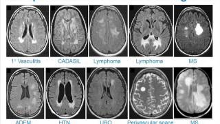 MRI Uses in MS [upl. by Aticnemrac696]