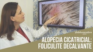 Alopecias Cicatriciais Foliculite Decalvante [upl. by Peer827]