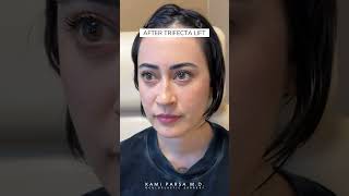 Eye Bags Goodbye Before and After Trifecta Lift with Dr Kami Parsa [upl. by Siegfried641]