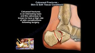 Calcaneal Fractures Skin amp Soft Tissue Condition  Everything You Need To Know  Dr Nabil Ebraheim [upl. by Eidorb]