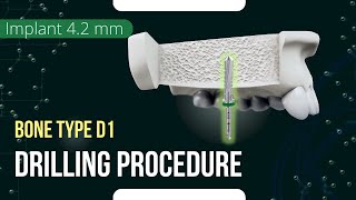 Drilling procedure for XGate Dental X11 and X3 PureampPorous Implant 42 mm diameter bone type D1 [upl. by Atiuqrehs644]