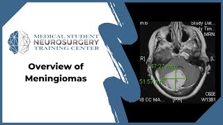 Overview of Meningiomas [upl. by Noivad]