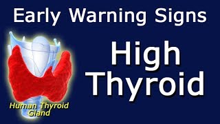 High Thyroid Early Warning Signs [upl. by Yecnay]