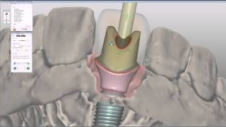 Customized zirconia abutment on titanium base CAD Design [upl. by Desdamonna563]