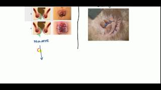 Hemorrhoids Lecture for USMLE [upl. by Cordie338]