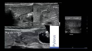 Hypertrophic Pyloric Stenosis amp Ultrasound [upl. by Joappa]