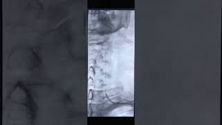 Treatment of Vertebral Artery Stenosis Radial Approach [upl. by Binnie25]