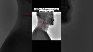 HUGE cervical spine osteophytes causing dysphagia [upl. by Halsted86]