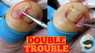 DOUBLE INGROWN TOENAIL REMOVAL FOREVERToe Nail Surgery by The Toe Bro [upl. by Cyler]