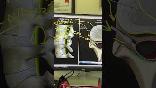 Neural Foraminal Stenosis  NonSurgical Relief Here [upl. by Burkhart]