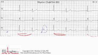 ECG Interpretation Tutorial  ChalkTalk 03  Advanced Level [upl. by Aiclid379]