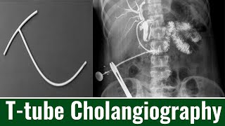 Ttube Cholangiography When is Ttube Cholangiography Performed Cholangiogram Purpose amp Procedure [upl. by Ayatal]